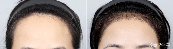 Before/After