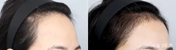 Before/After