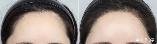 Before/After