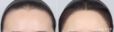 Before & After