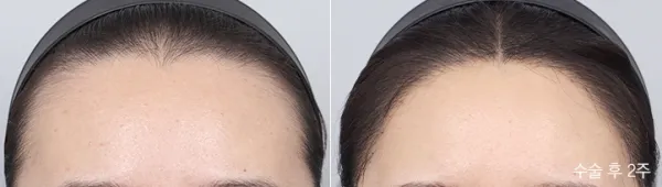 Before/After