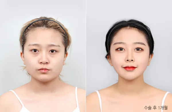 Before/After
