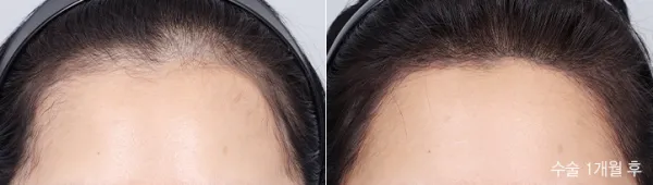 Before/After