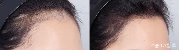 Before/After