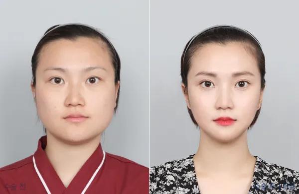 Before/After