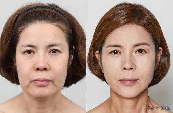 Before/After