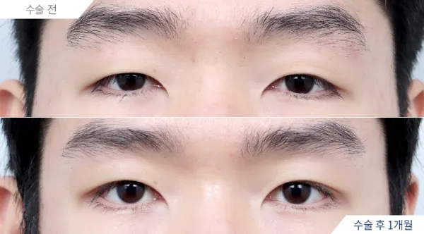 Before/After
