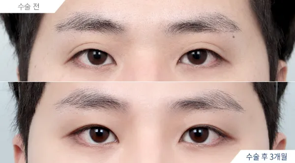 Before/After