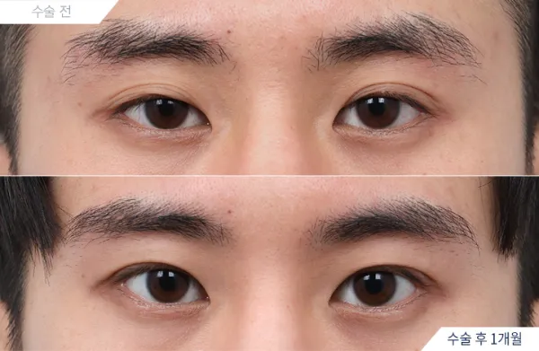 Before/After