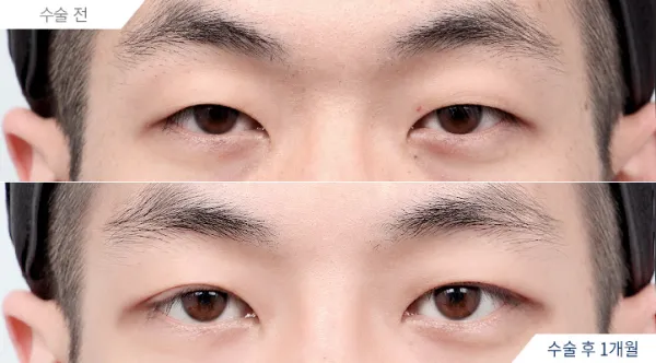 Before/After