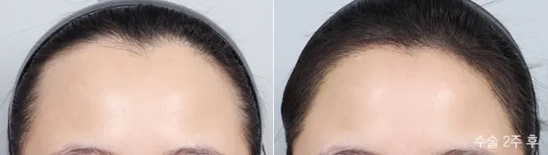Before/After