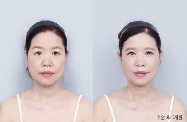 Before/After
