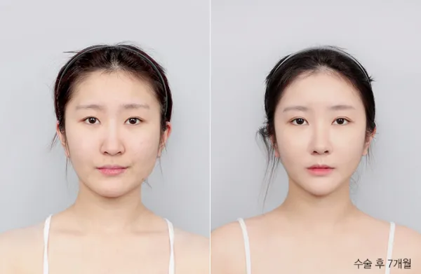 Before/After