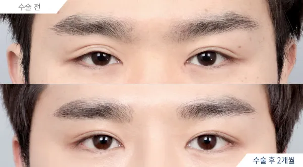 Before/After