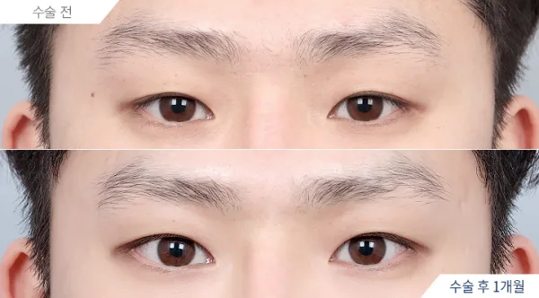 Before/After
