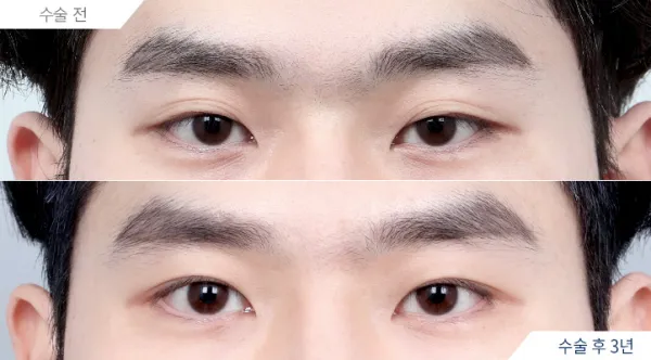 Before/After