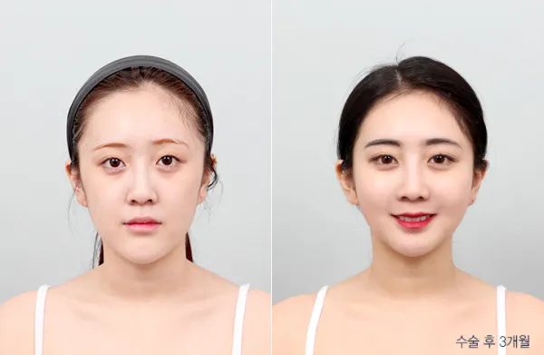 Before/After