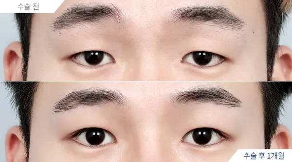 Before/After