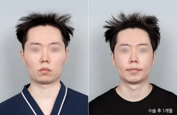 Before/After
