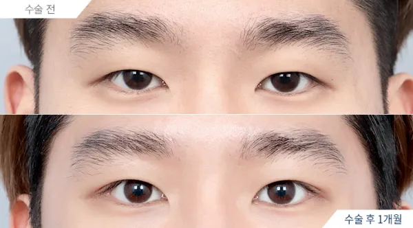 Before/After