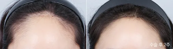 Before/After
