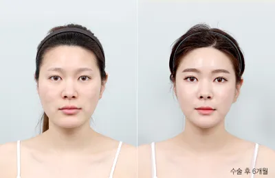 Before & After