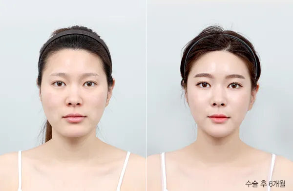 Before/After