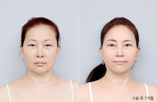 Before/After