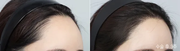 Before/After