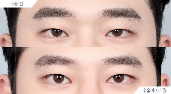 Before/After
