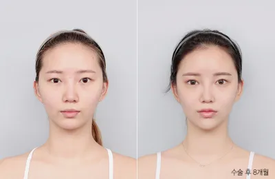 Before & After