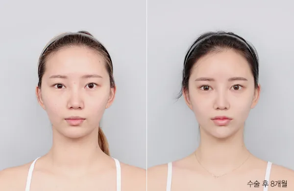 Before/After