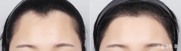 Before/After