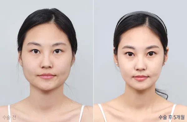 Before/After