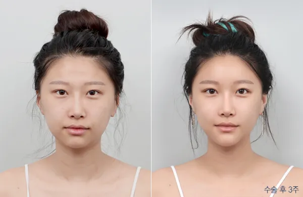 Before/After