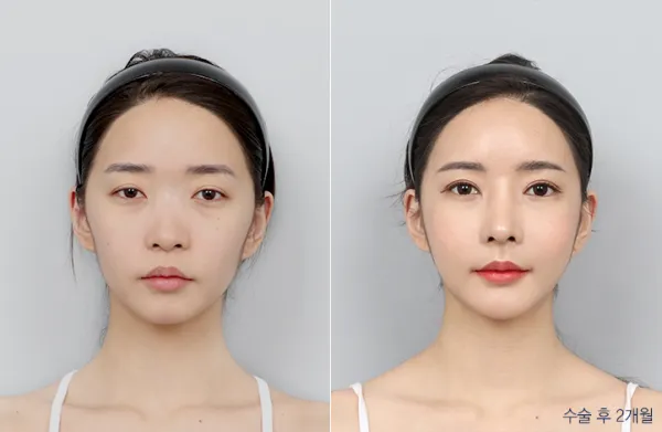 Before/After