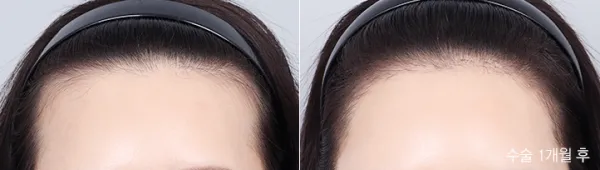 Before/After