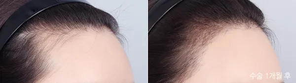 Before/After
