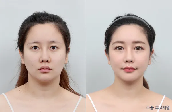 Before/After