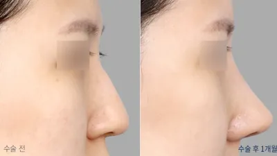 Before & After