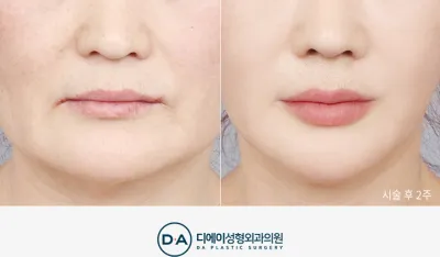 Before & After