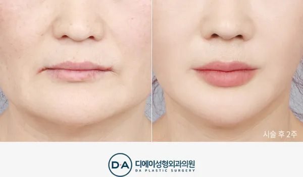 Before/After