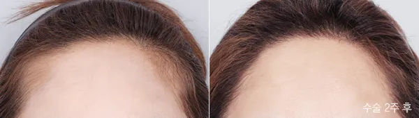 Before/After