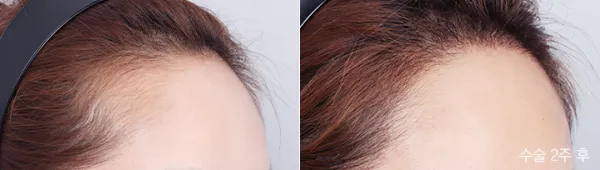 Before/After