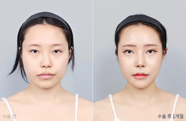 Before/After
