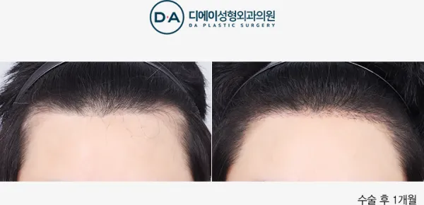 Before/After