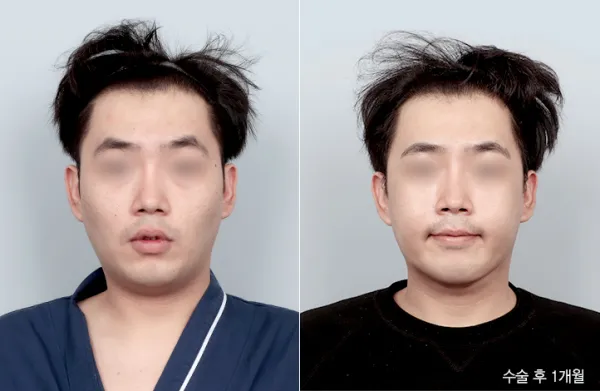 Before/After