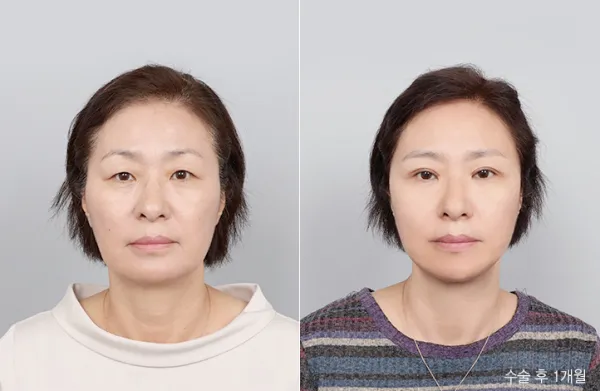 Before/After