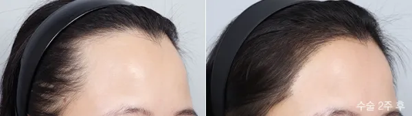 Before/After