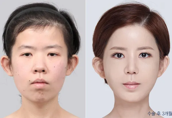Before/After